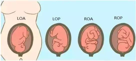 左枕前(loa),左枕后(lop),右枕前(roa),右枕后(rop)胎位一般分为头位