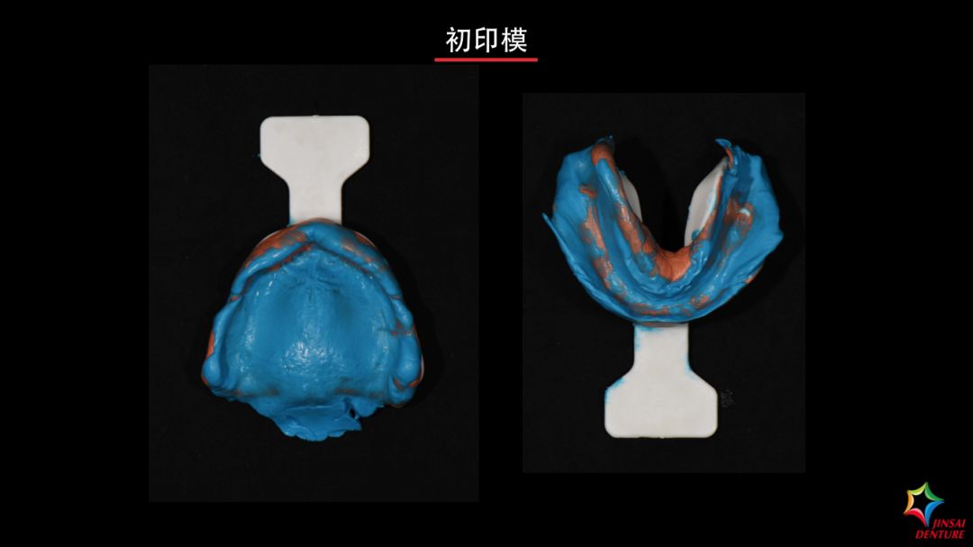 金赛义齿bps生物功能性全口义齿修复病例及试戴视频