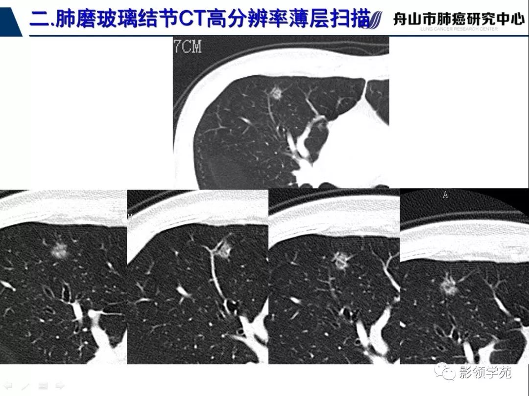 肺磨玻璃结节ct精确检查技术的临床应用