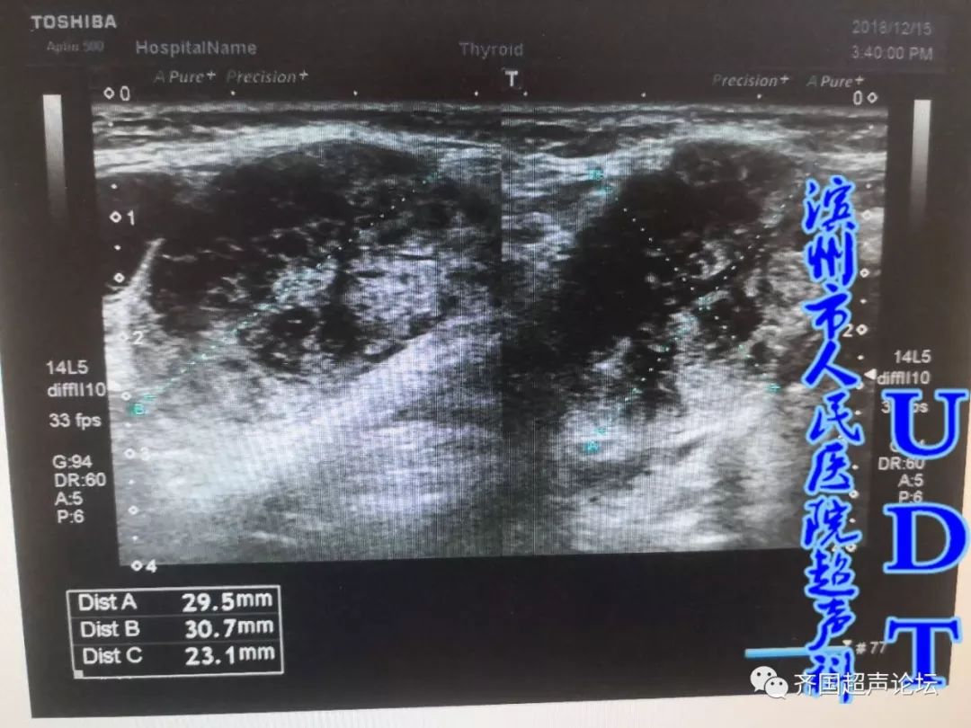 慢性涎腺炎61igg4相关性涎腺炎udt病例533534