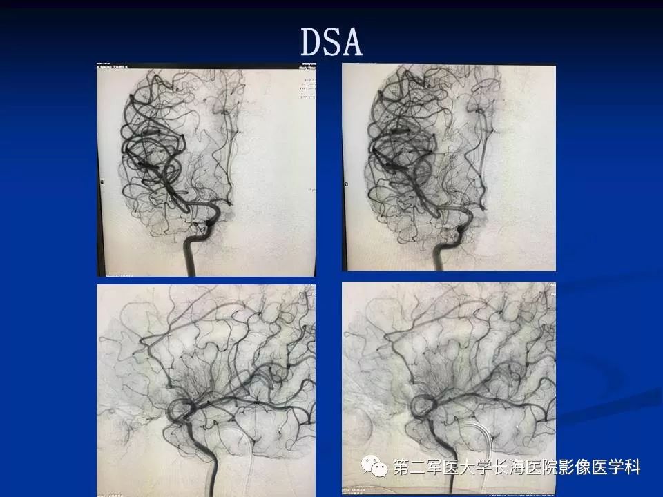 出血,软化,形成梗死灶的一类血管性疾病,大约50%的脑静脉血栓形成将