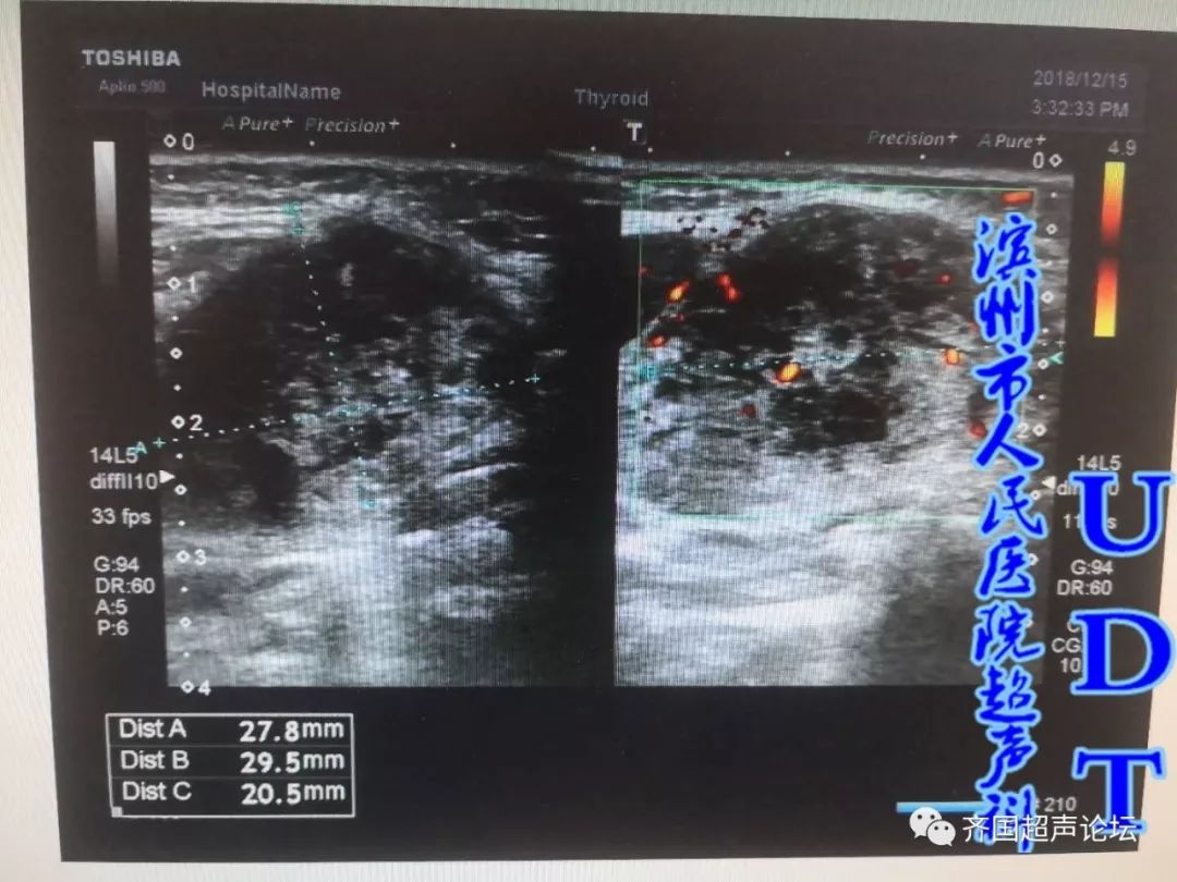 慢性涎腺炎61igg4相关性涎腺炎udt病例533534