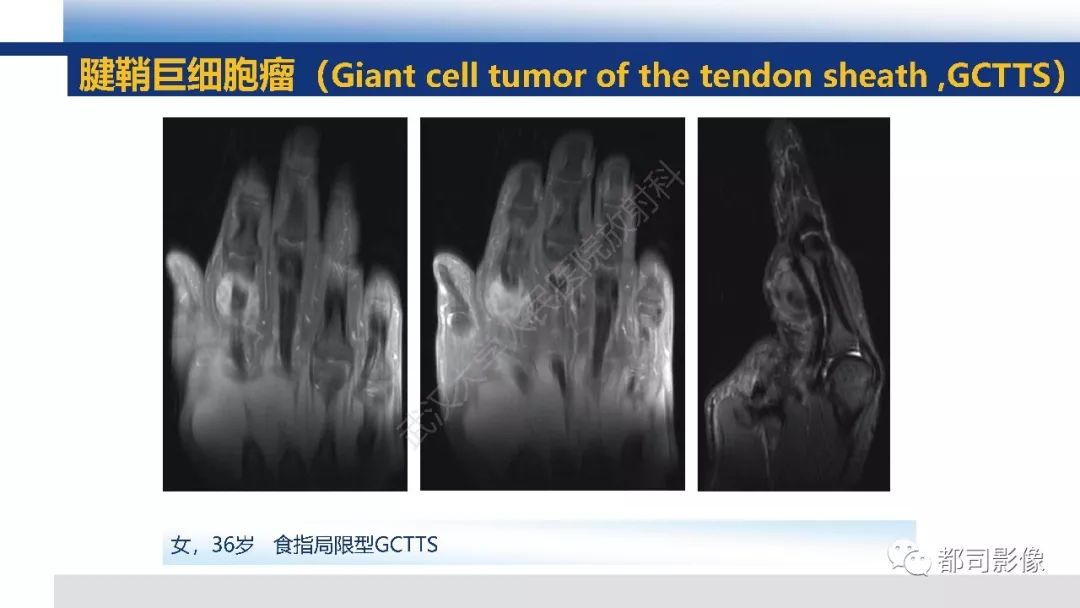 腱鞘巨细胞瘤影像诊断及鉴别诊断