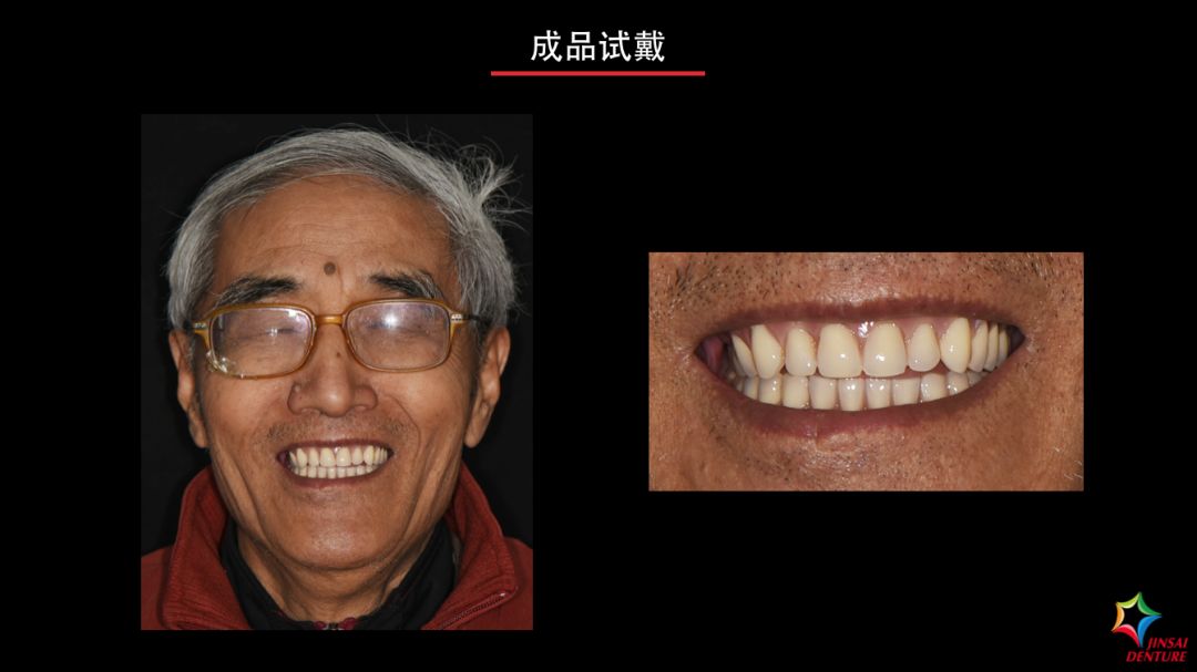 金赛义齿bps生物功能性全口义齿修复病例及试戴视频