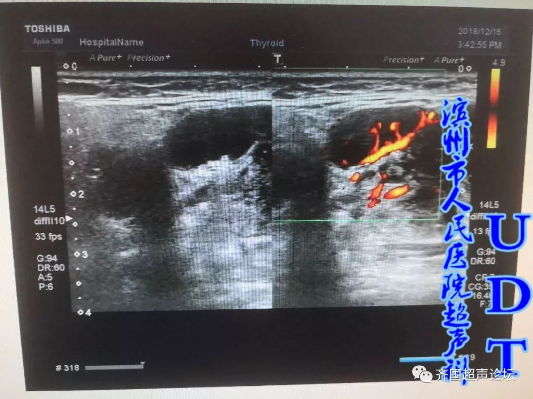 慢性涎腺炎61igg4相关性涎腺炎udt病例533534