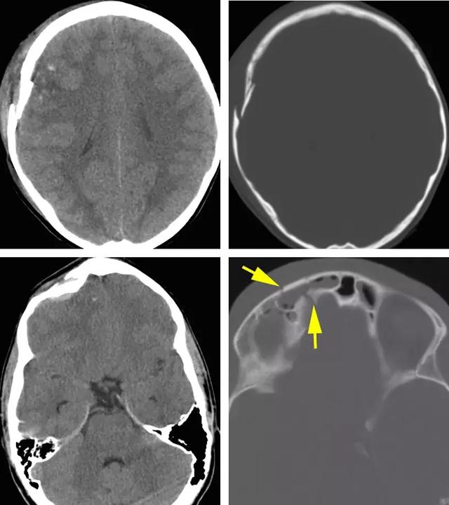 ct骨窗可高分辨率显示颅骨,使那些通过正侧位x线检查容易忽视的小的