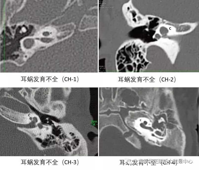 耳蜗与前庭之间分隔正常,但比正常耳蜗小(图3.耳蜗发育不全(ch)5图2.