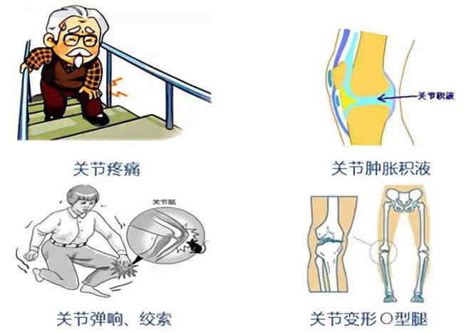 老人骨性关节炎金堤古方骨科医生说这样下楼梯更护膝盖很有效