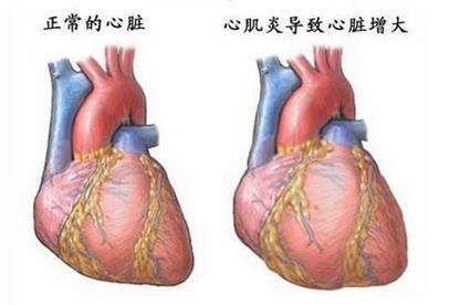 孩子小感冒家长也应重视！小心是性命攸关的心肌炎！