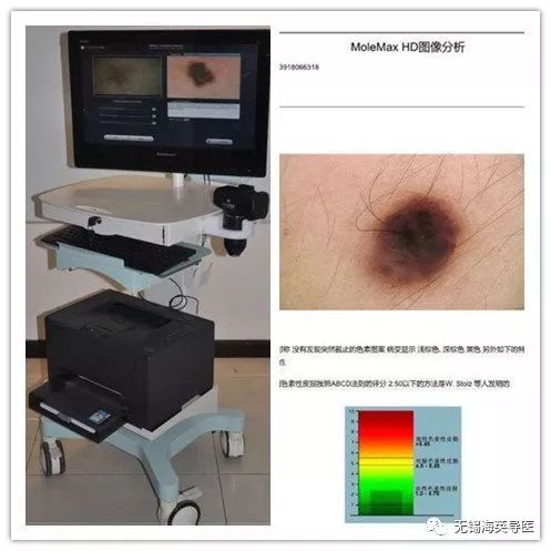 痣用手抠破了怎么办