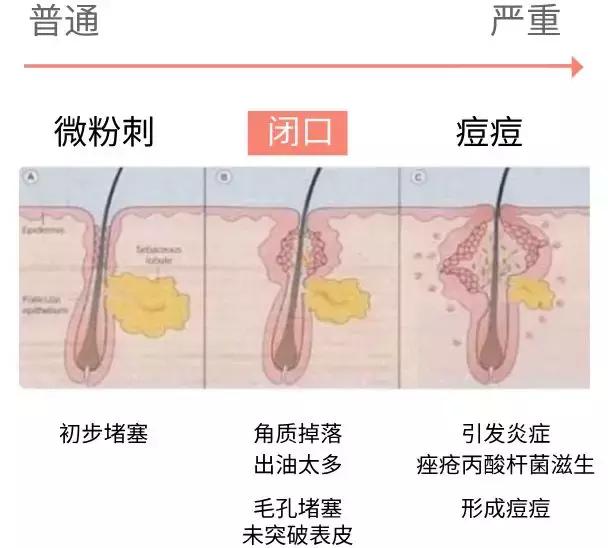 闭口人口_闭口粉刺图片(2)