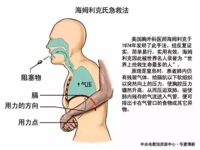 海姆立克急救法操作方法