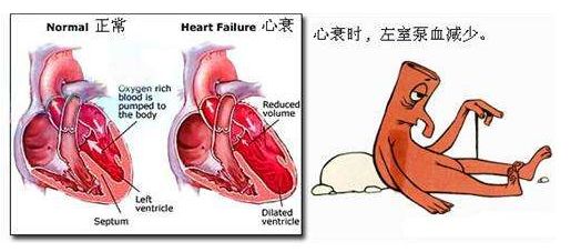 心衰脚肿怎么办