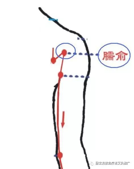 二十四种疑难杂症的刺血疗法