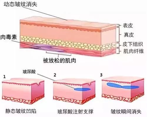 肉毒素与玻尿酸除皱原理