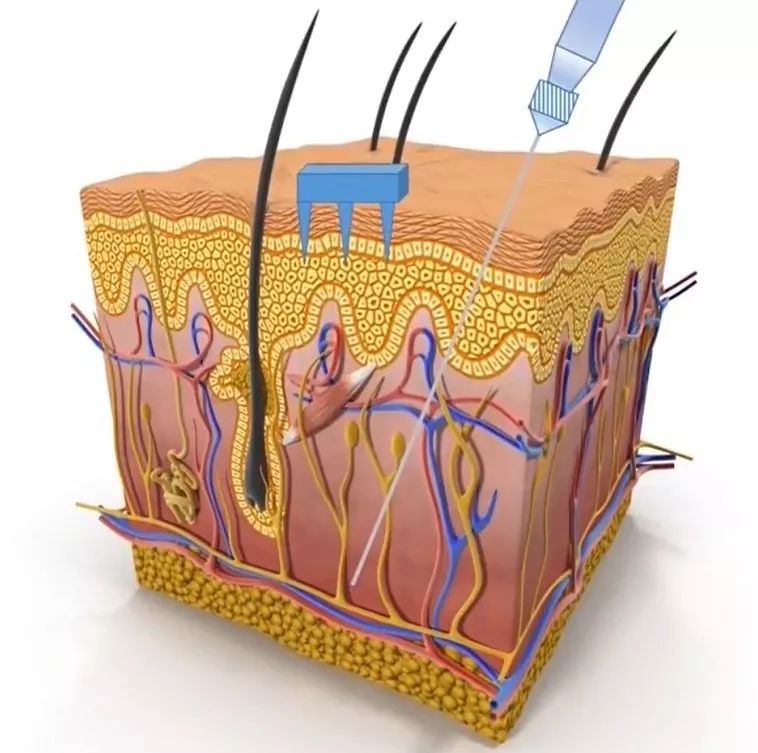 传统抽血的皮下针和微针的对比
