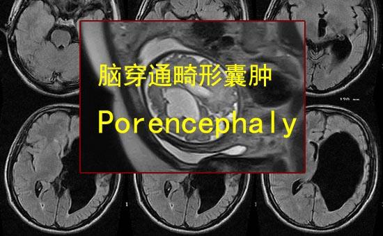 脑穿通畸形囊肿临床症状及治疗方法