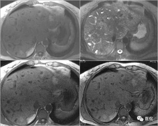 遗传性肝部疾病,无原发病史 肝硬化表现,来看看ct平扫