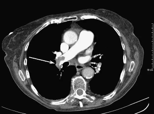 肺动脉ct示肺栓塞