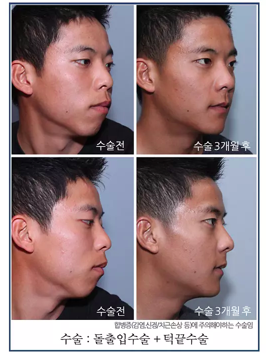 韩国uc 首尔牙科突嘴矫正手术案例