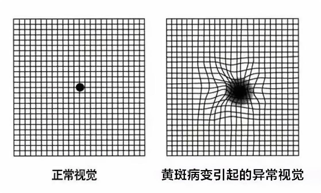 关于湿性老年性黄斑病变治疗的一些问题