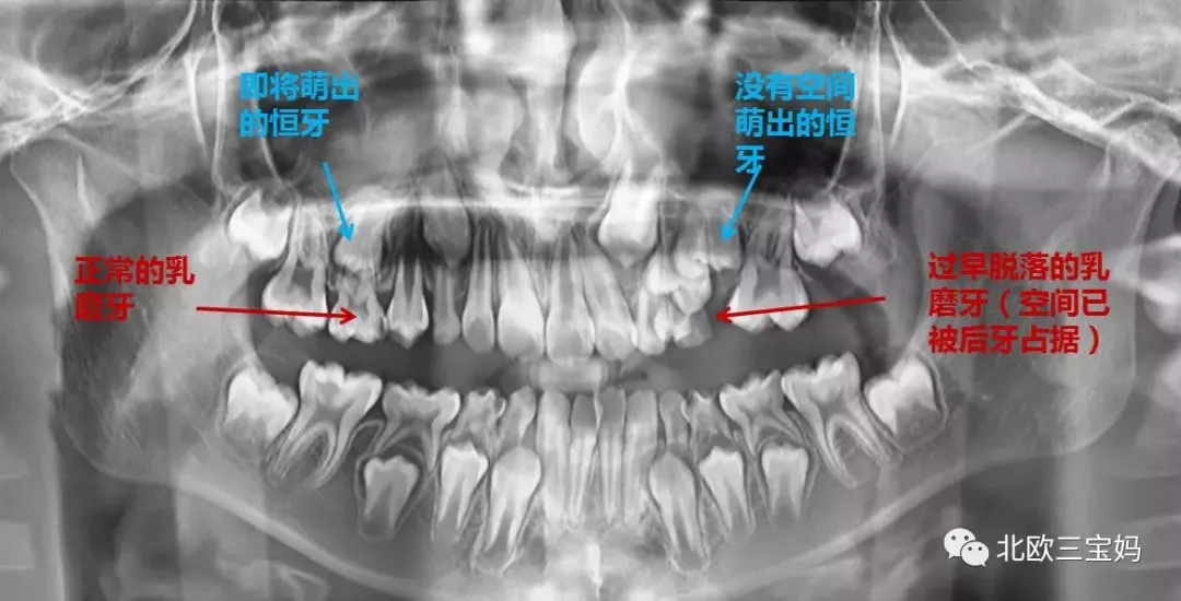 导致这个位置上的恒牙没地方长出来,只能长歪 以后的恒牙长得东倒西歪