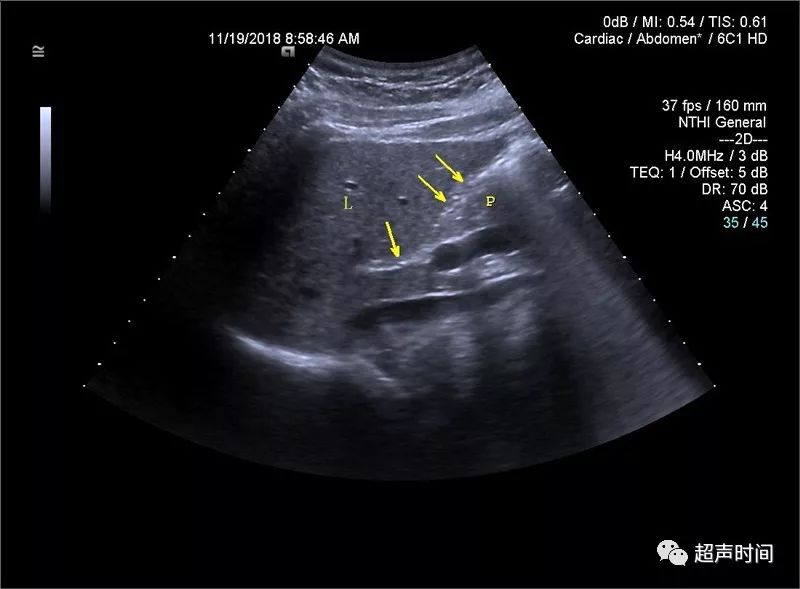 超声典型病例:胃癌肝转移_韧带