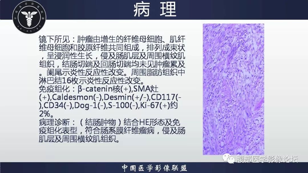 (结肠肿物)肠系膜纤维瘤病