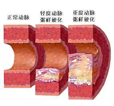 动脉粥样硬化心血管疾病与他汀兄弟的那些事