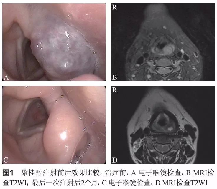 文献推荐 | 内镜辅助下聚桂醇注射治疗咽喉部血管瘤