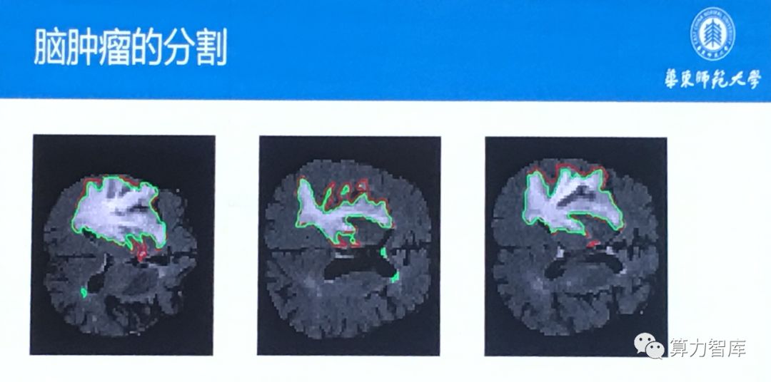 当人工智能遇上医学影像光环下遭遇拦路虎