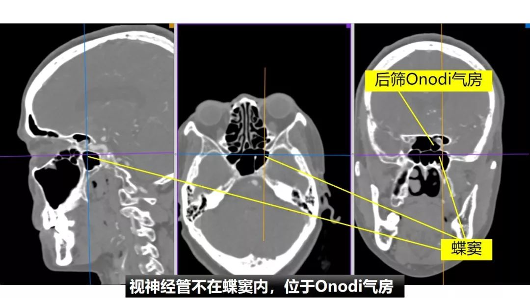 【正海-妙术视界】| 赵天智副教授 :前床突磨除与脑脊液漏处理---中鼻