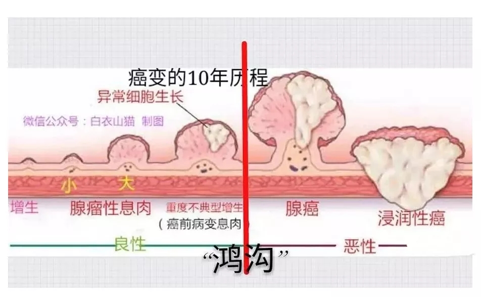 2,怎么才能尽早发现大肠息肉?