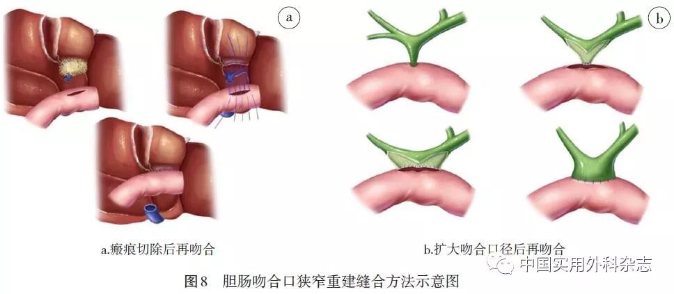 如原行胆管-十二指肠吻合,推荐改为胆管-空肠roux-en-y吻合