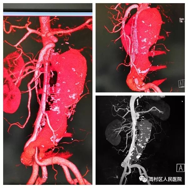 腹主动脉瘤破裂命悬一线,全力救治缔造一场生命的奇迹