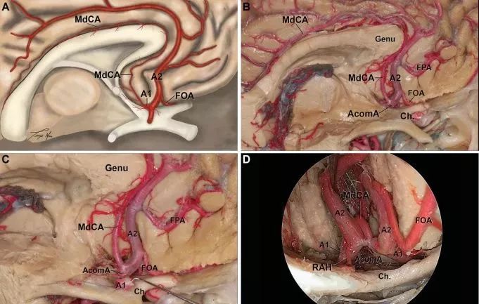 胼胝体下动脉在经颅和内镜经鼻手术中的应用解剖