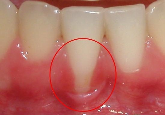 牙龈萎缩严重是怎么回事?只覆盖牙齿的根部了,有修复的办法吗?