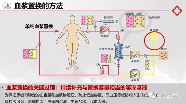 治疗性血浆置换术单纯血浆置换模式流程操作指导