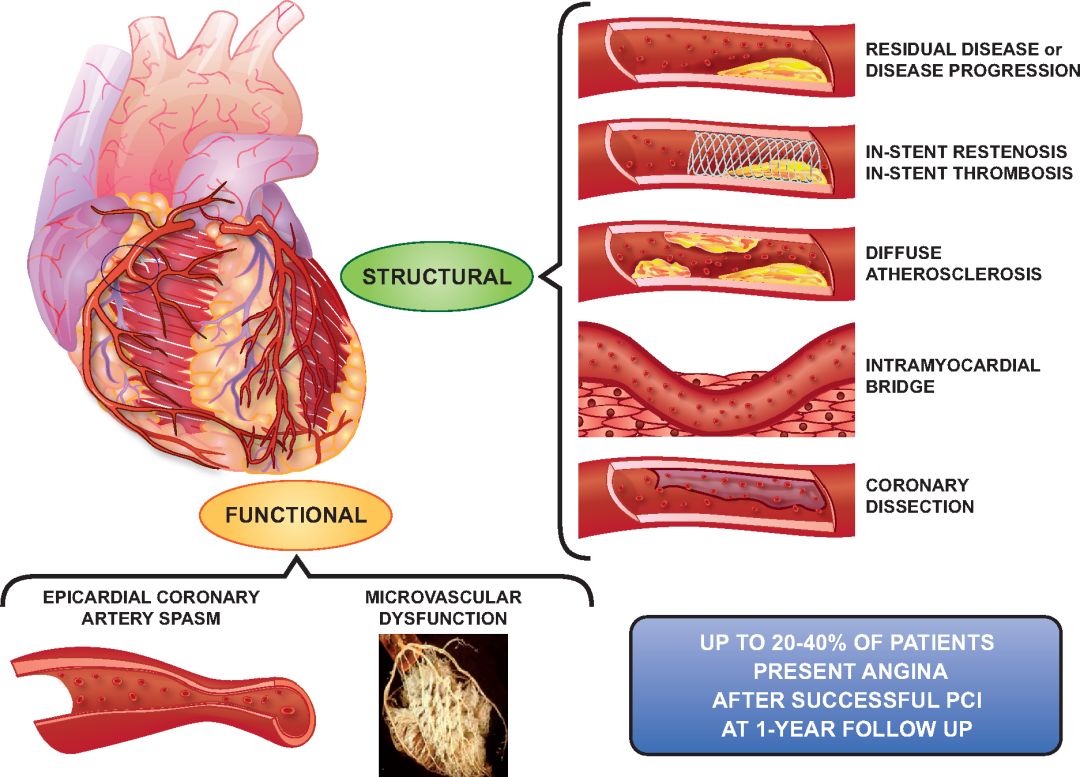 成功pci后持续性或复发性心绞痛的病理生理学是异质性的.