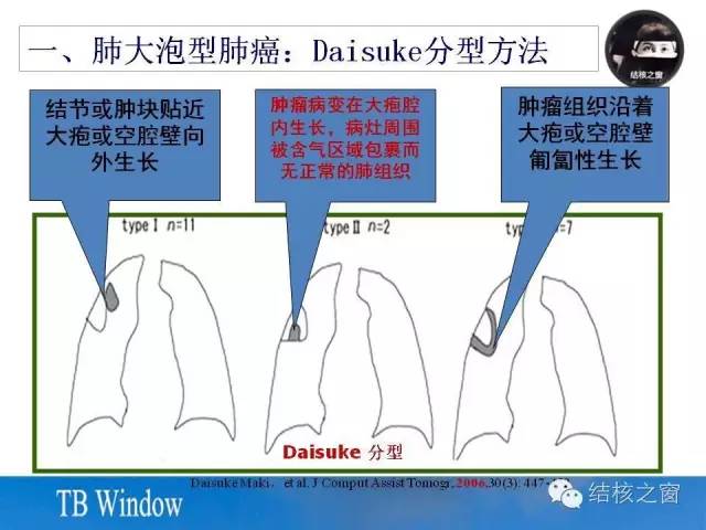 z型腔怎么搭_囗腔溃疡怎么治疗(2)