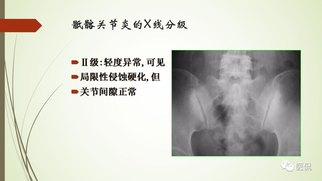 强直性脊柱炎x线表现医学影像经典