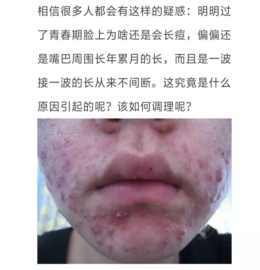 嘴巴周围长痘痘是什么原因引起的?该如何调理?