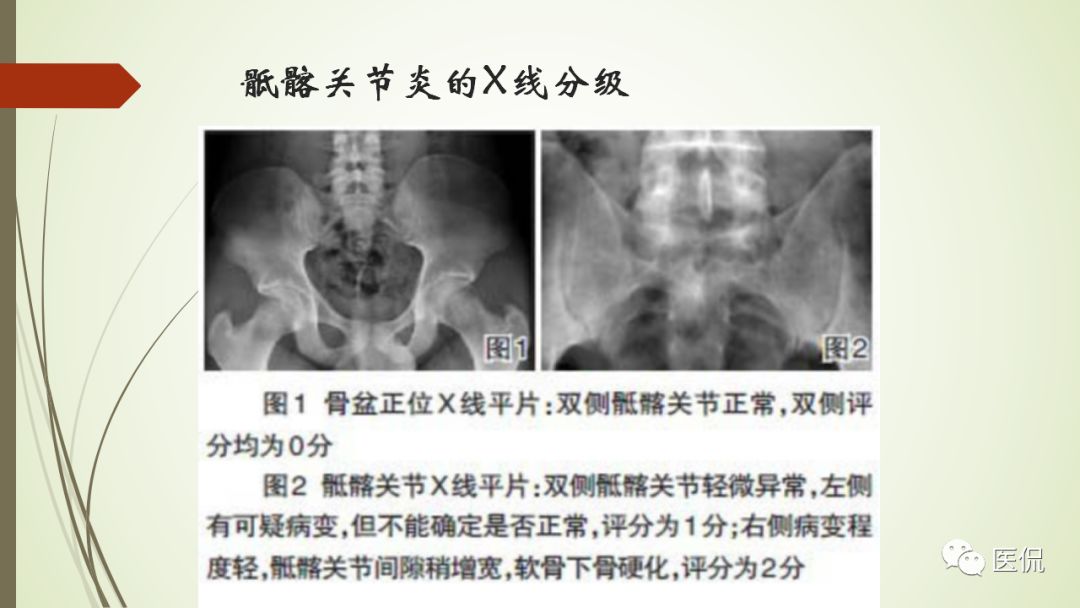 强直性脊柱炎x线表现(医学影像经典)