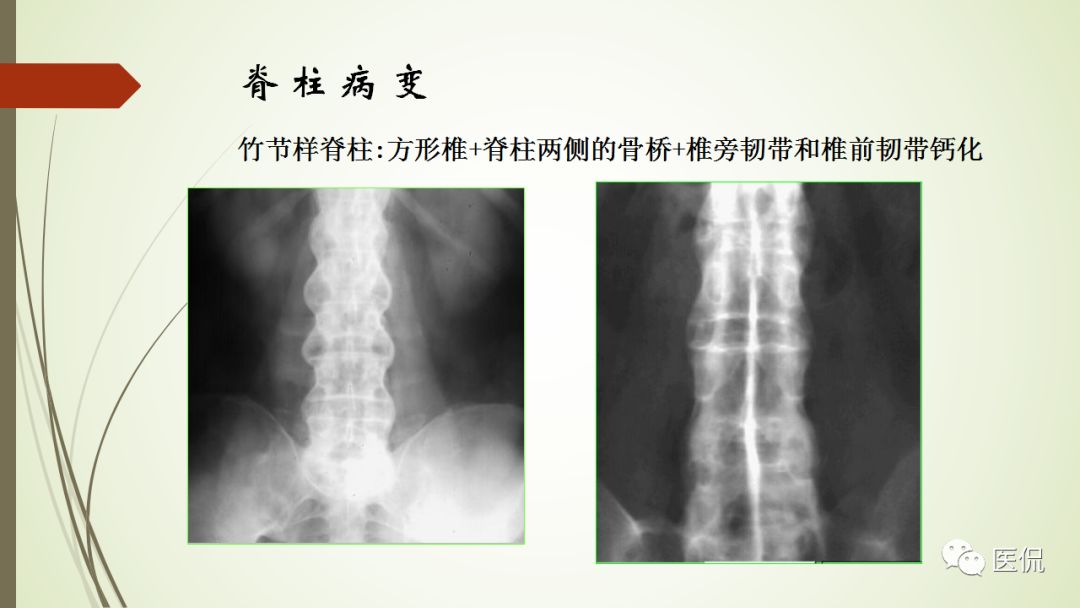 强直性脊柱炎x线表现(医学影像经典)