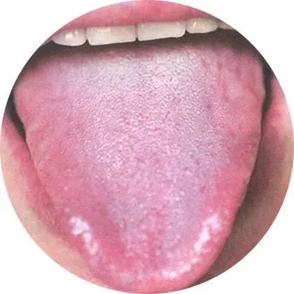为正常舌苔或疾病初起,或显示病情清浅.