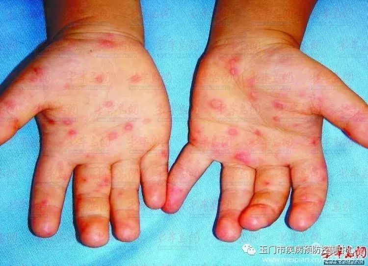 手足口病是一种儿童常见传染病,以发热,口腔粘膜疱疹或溃疡,手,足,臀