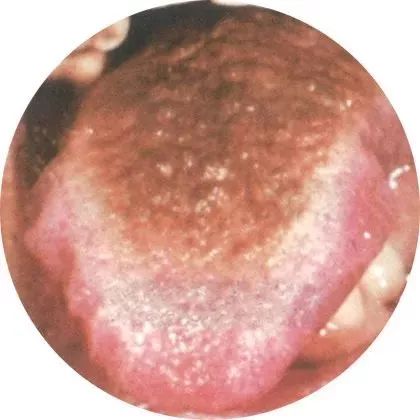 史上最全:130种高清舌诊图谱(吐血整理,建议收藏)_舌苔