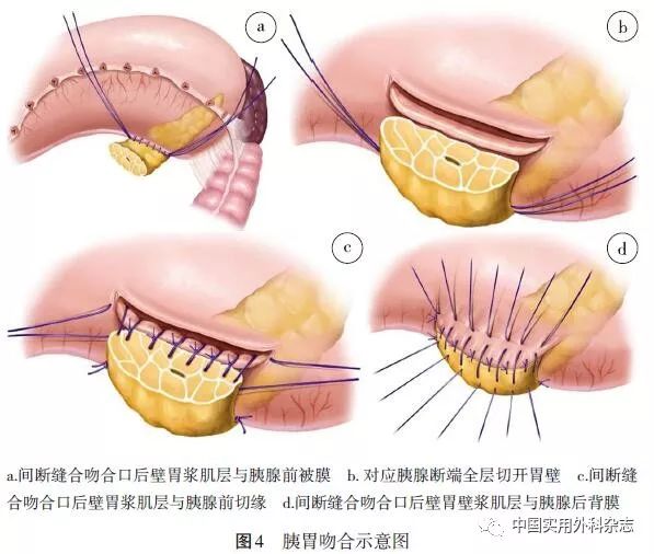 8 腹腔镜或机器人手术系统的胰肠或胰胃吻合腹腔镜或机器人手术系统