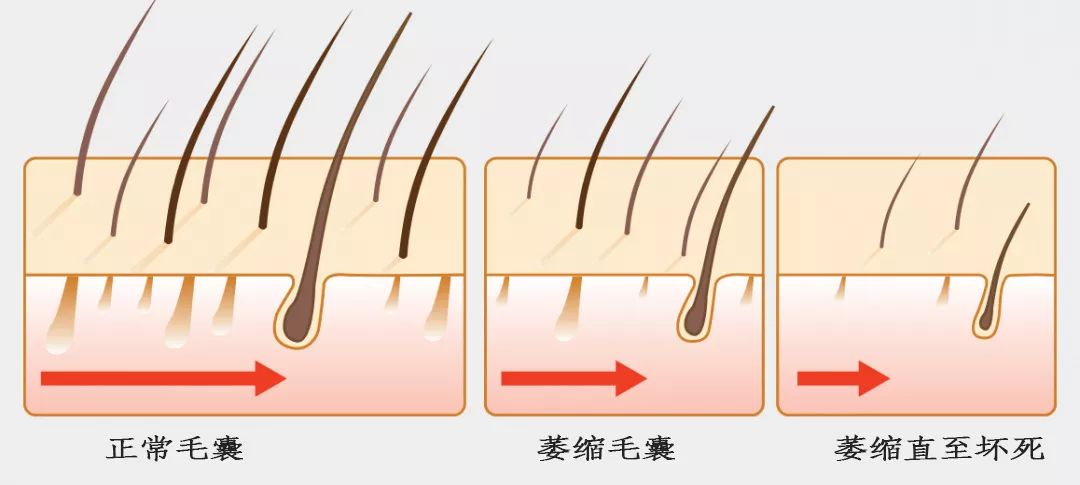 正常毛囊↓ 萎缩毛囊↓ 坏死毛囊↓