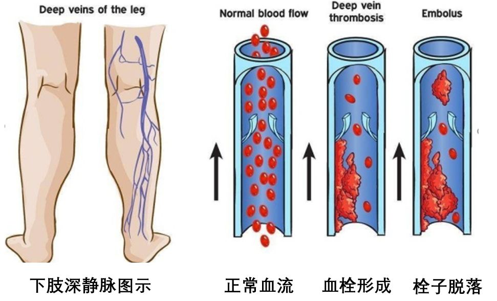 静脉血栓是小毛病听医生讲完吓出一身冷汗